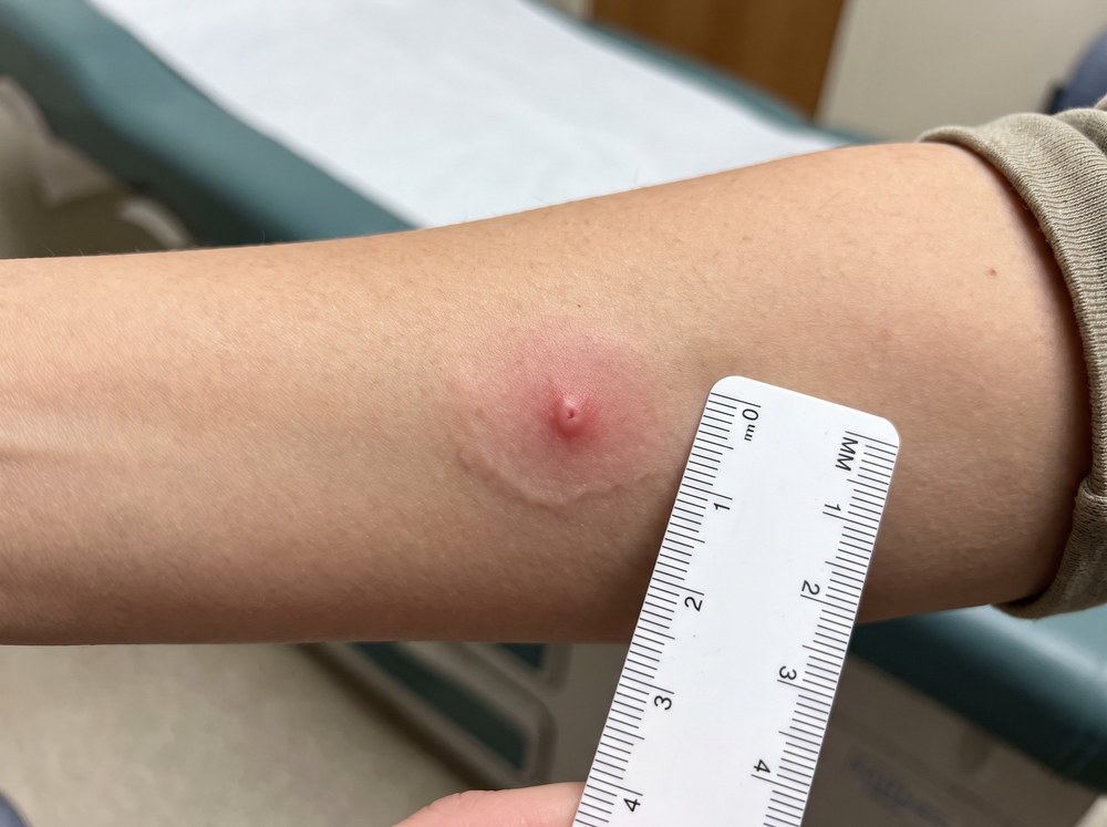 Close-up photo of a fresh red welt from an Asian needle ant sting with mild surrounding redness on skin